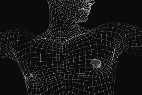 Kanker Payudara Pada Pria, Kenali Gejala Dini dan Penanganannya