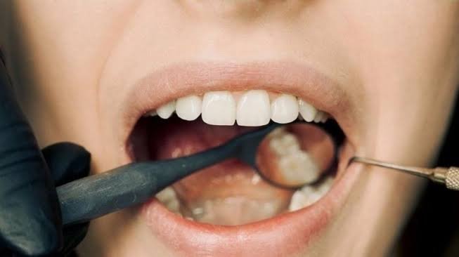 Ayo Periksa Gigi 6 Bulan Sekali untuk Deteksi Dini Masalah Mulut